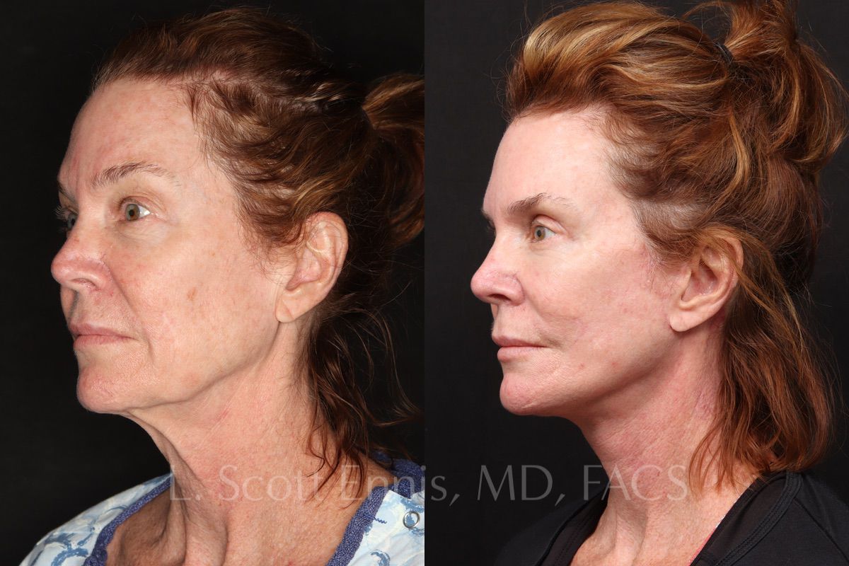 Deep Plane Facelift before and after