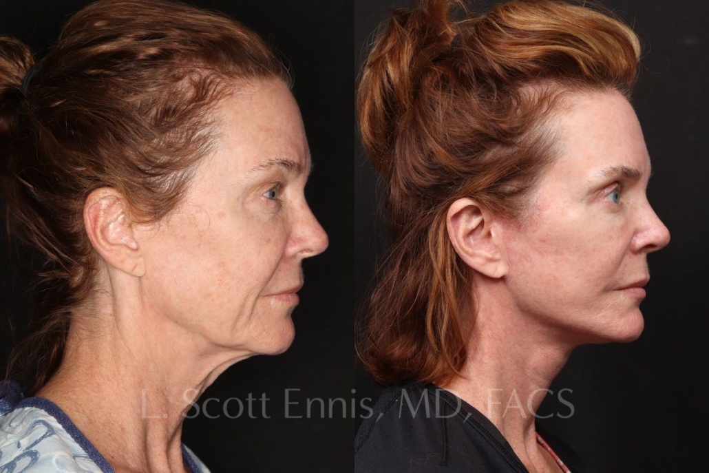 Deep Plane Facelift before and after