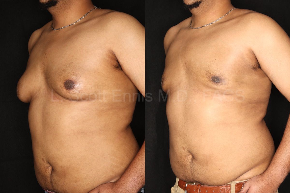 gynecomastia,droopy male breasts,skin removal,lift - New Gynecomastia