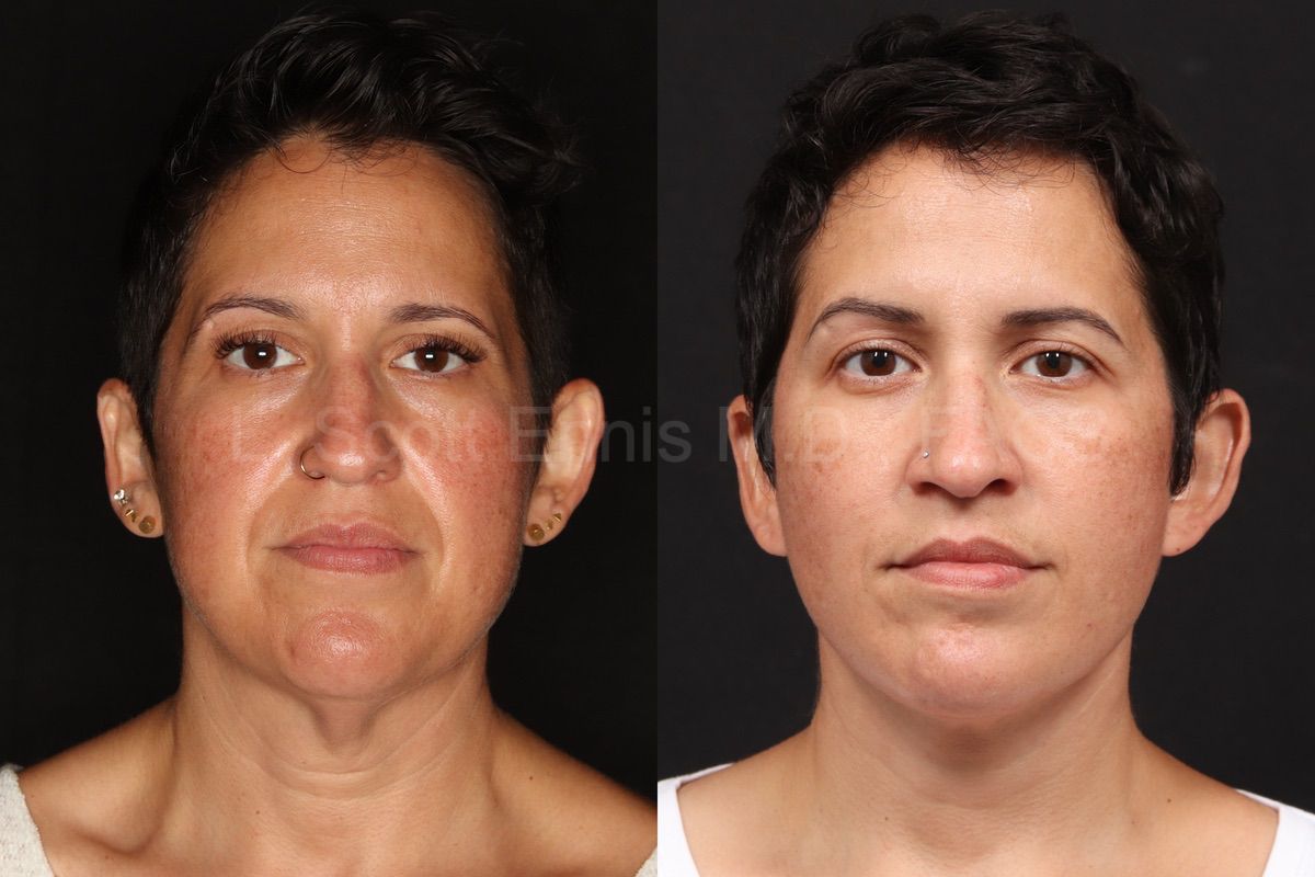 Facelift: original patient comparison, view 1.