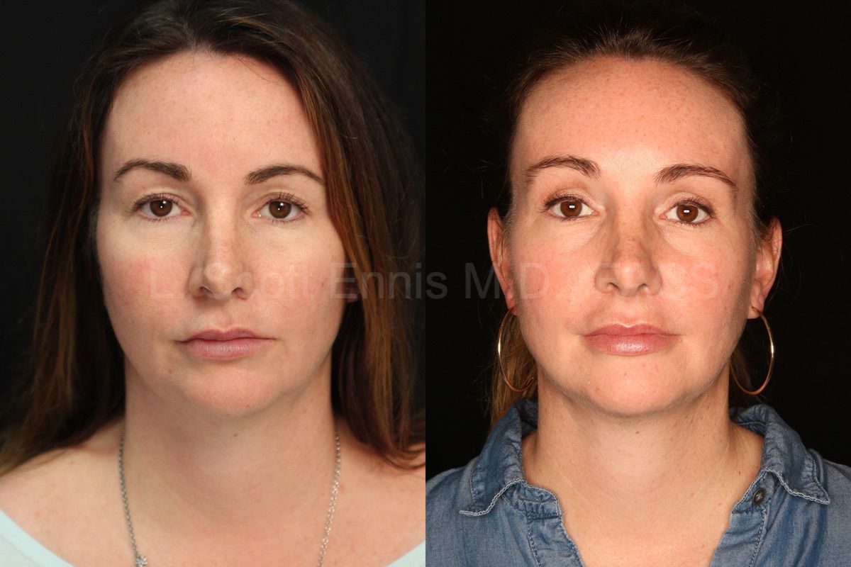 Eyelid Surgery: original patient comparison, view 1.