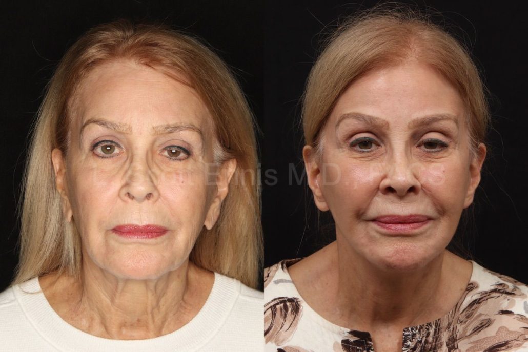 Deep Plane Facelift Surgery in Boca Raton - Natural Looking