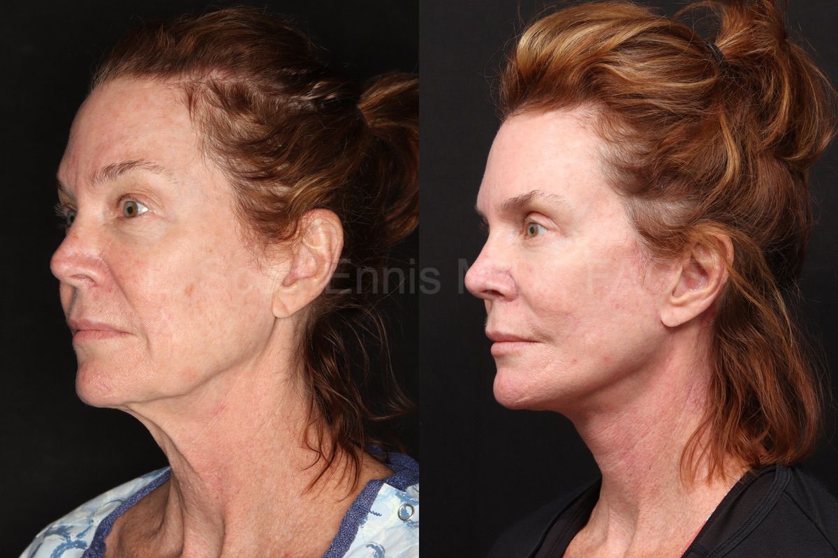 Facelift with Buccal Fat Pad Removal and Profound RF on the Neck - Carolina  Facial Plastics