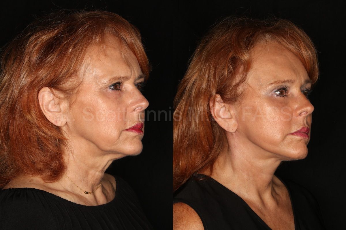 Micro Lift in Geneva - Dr. Prevot, Cosmetic and Reconstructive Surgery