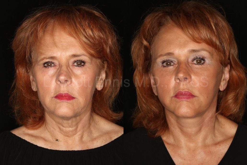 Boca Raton cosmetic surgeon warns of new face slimming, plastic surgery  trend