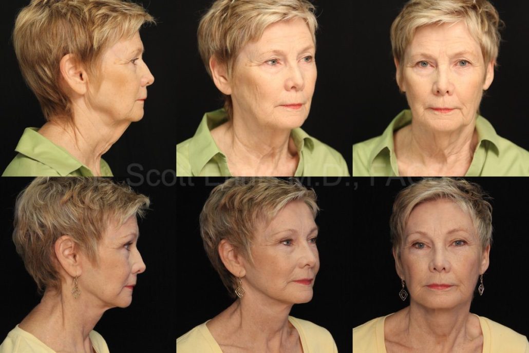 Facelift-Brow-lift
