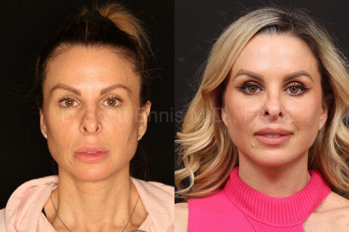 Steely Plastic Surgery - Before & After: 32 year old woman had