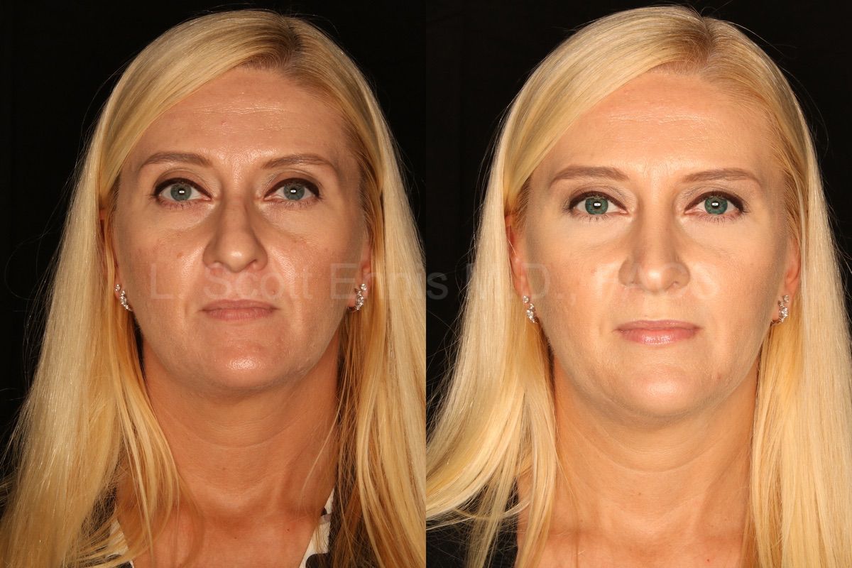 Eyelid Surgery: original patient comparison, view 2.