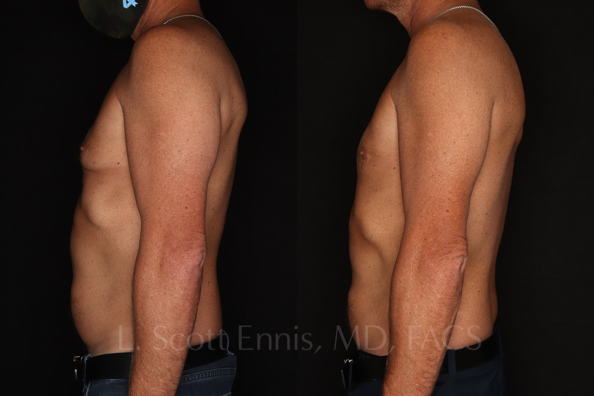 gynecomastia 45 male before and after photos