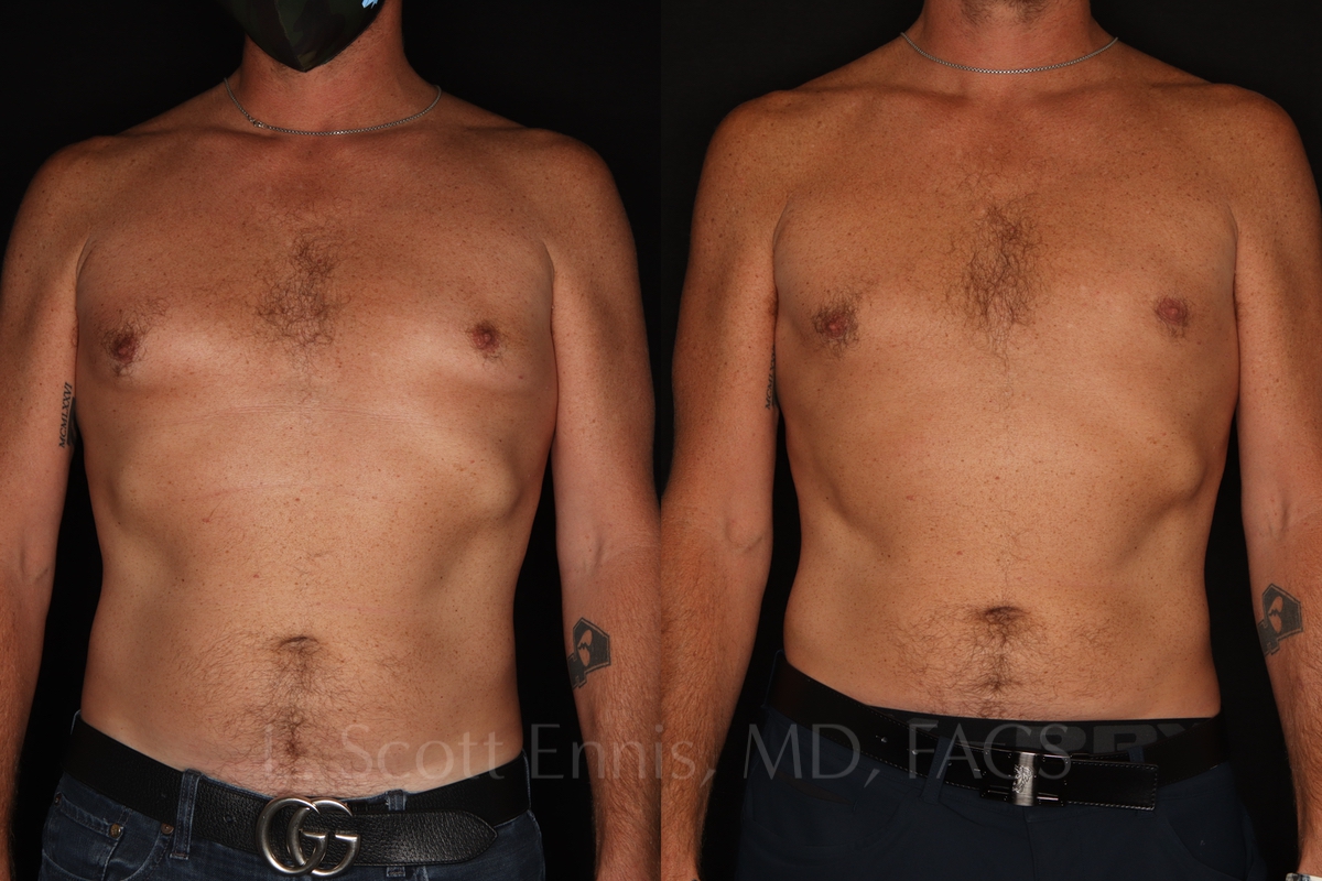 Gynecomastia before and after photos 45 male
