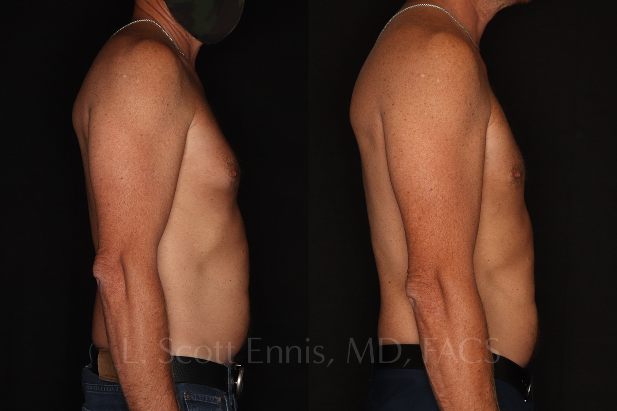 Gynecomastia before and after photos 45 male
