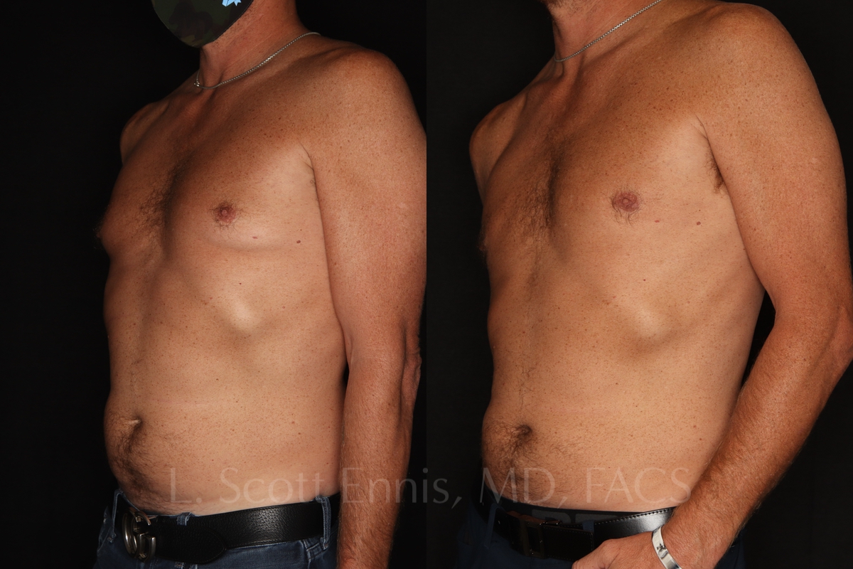 gynecomastia 45 male before and after photos