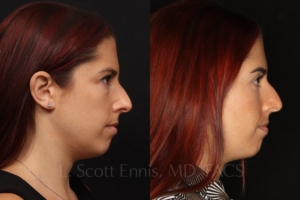 lower blepharoplasty 34 female before and after photos