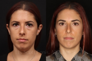 lower blepharoplasty 34 female before and after photos