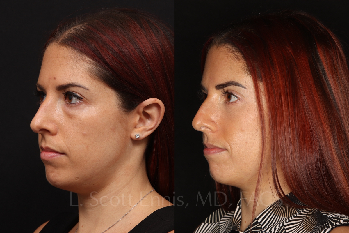lower blepharoplasty 34 female before and after photos