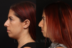 lower blepharoplasty 34 female before and after photos