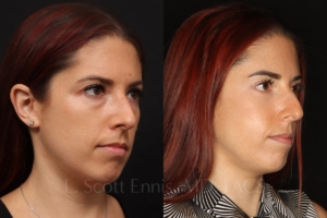 lower blepharoplasty 34 female before and after photos