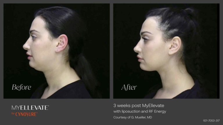Neck Lift with Suture Suspension & No Scars by Dr. Ennis in Boca Raton