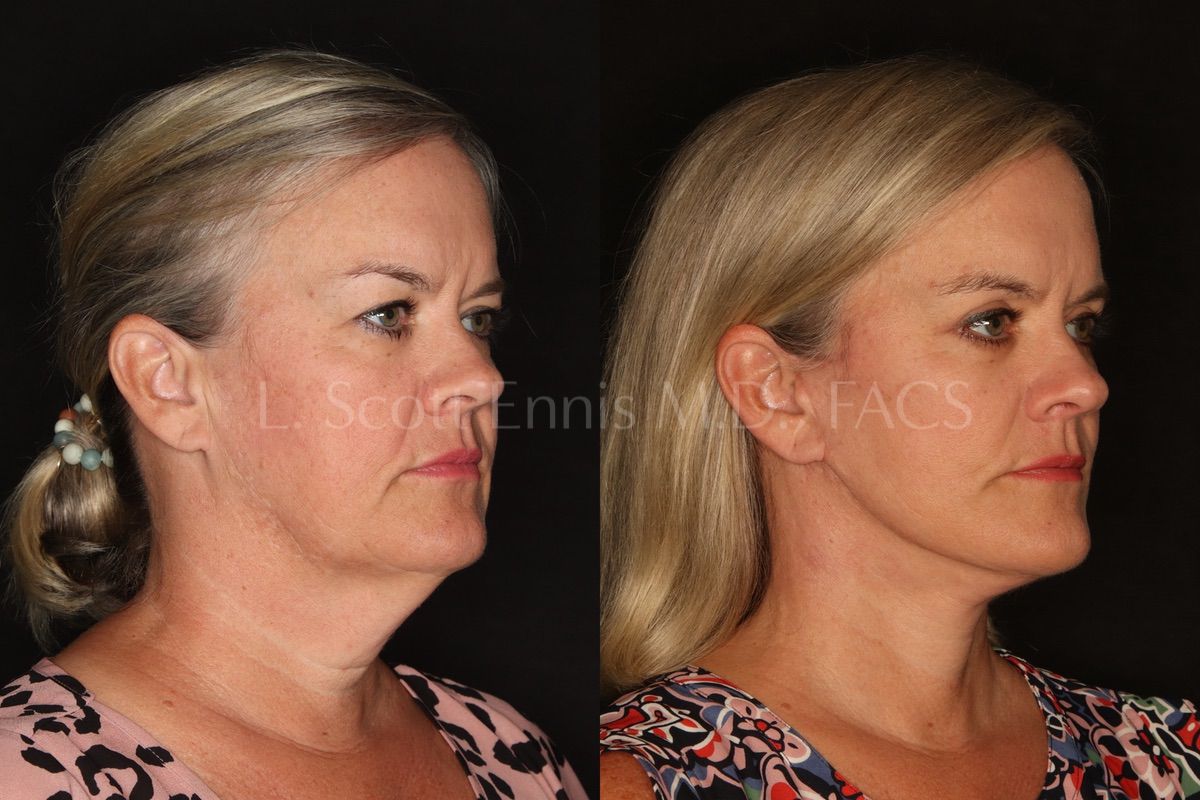 Blepharoplasty (eyelids) SurgeryBefore picture