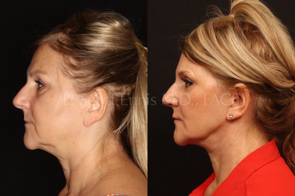 Deep Plane Facelift / Buccal Fat Pad Removal / Obagi Blue Peel