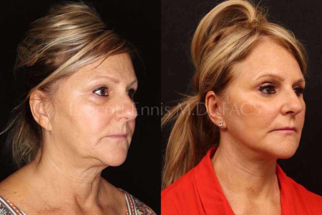 Deep Plane Facelift / Buccal Fat Pad Removal / Obagi Blue Peel