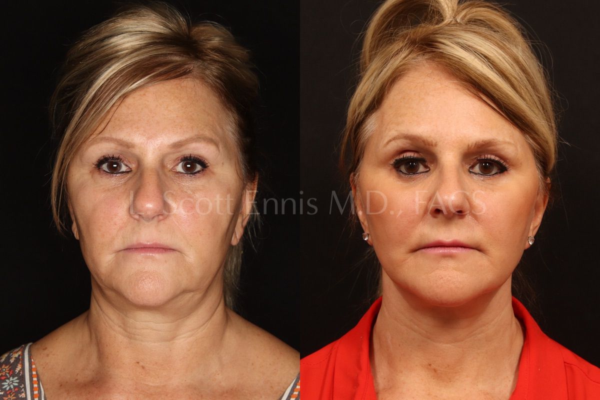 Buccal fat pad removal – Before and After Pictures *