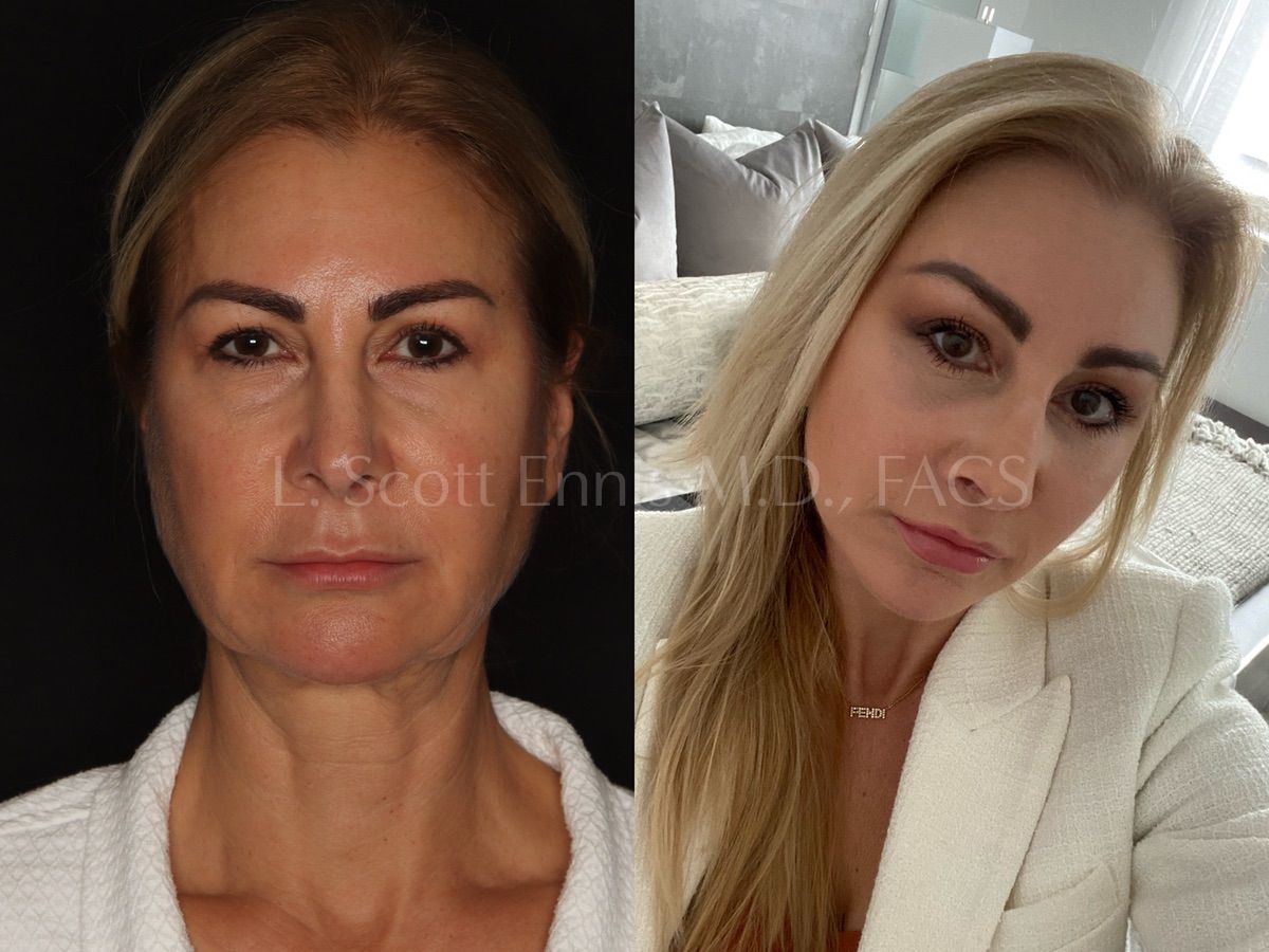 Browlift Surgery Before & After Photos by Dr. Ennis | Ennis Plastic Surgery
