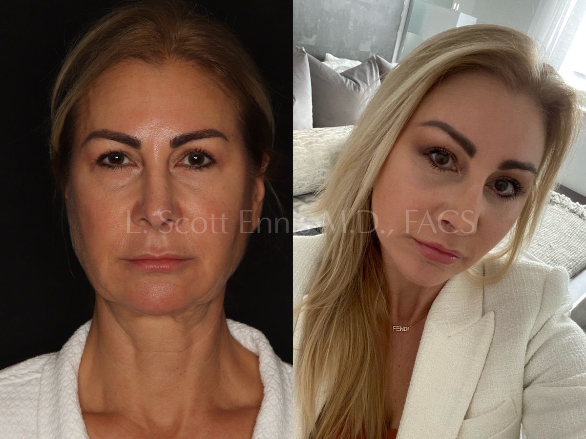 Facelift Before & After Photos by Ennis Plastic Surgery in Boca Raton