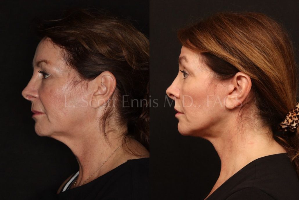 Facelift-buccal-fat-pads-upperlip-56-yo-Before-and-After-Ennis-Plastic-Surgery-Palm-Beach-Boca-Raton-Destin-53626 (2)