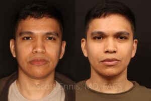 Buccal Fat Pad removal liposuction of the neck(Ennis Plastic Surgery Dr Scott Ennis Boca Raton Miami New york, beverly hills. 57221 2 Buccal Fat Pad removal
