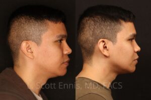 Buccal Fat Pad removal liposuction of the neck(Ennis Plastic Surgery Dr Scott Ennis Boca Raton Miami New york, beverly hills. 57221 3