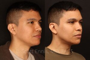 Buccal Fat Pad removal liposuction of the neck(Ennis Plastic Surgery Dr Scott Ennis Boca Raton Miami New york, beverly hills. 57221 4