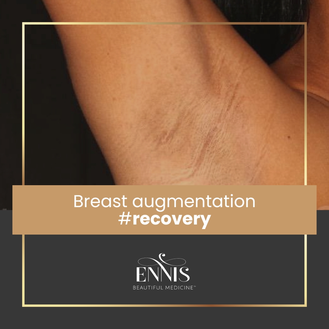 Breast Augmentation Recovery Timeline