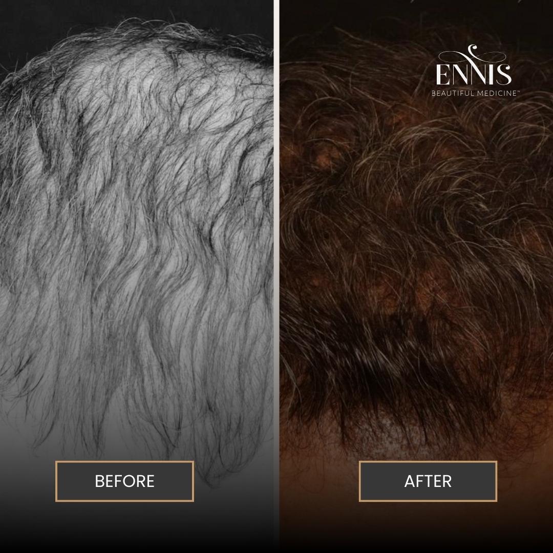Hair Transplant: original patient comparison, view 1.