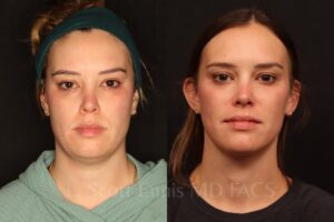 32 year old Liposuction of the neck with Mini-facelift -Before-and-After-Ennis-Plastic-Surgery-Boca-Raton-Miami-New-York 58619 (3) Liposuction of the neck with Mini-facelift before and after by Dr. Scott Ennis at Ennis Plastic Surgery in Boca Raton Fort Lauderdale Miami