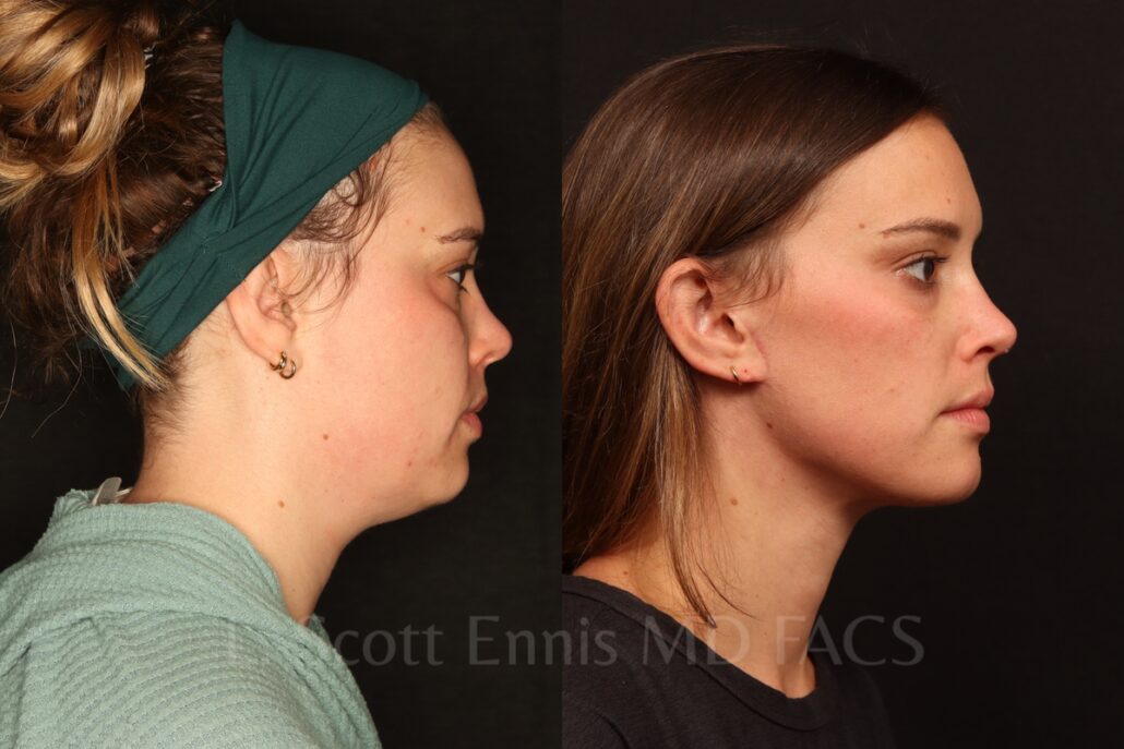 Liposuction of the neck with Mini-facelift before and after by Dr. Scott Ennis at Ennis Plastic Surgery in Boca Raton Fort Lauderdale Miami