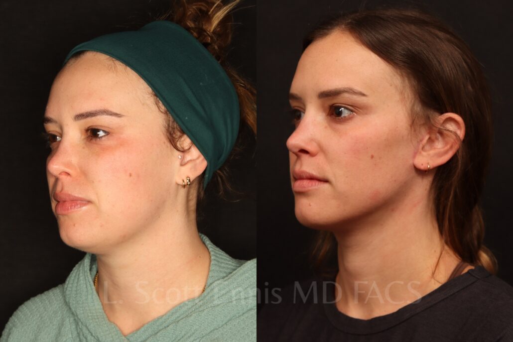 Liposuction of the neck with Mini-facelift before and after by Dr. Scott Ennis at Ennis Plastic Surgery in Boca Raton Fort Lauderdale Miami