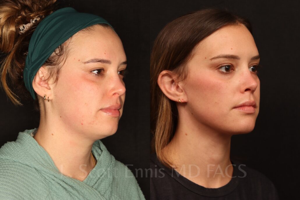 Liposuction of the neck with Mini-facelift before and after by Dr. Scott Ennis at Ennis Plastic Surgery in Boca Raton Fort Lauderdale Miami