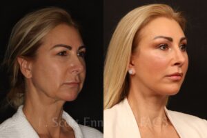 Endoscopic Brow lift Lower blepharoplasty deep plane facelift upper lip lift buffalo fat pad removal Ennis Plastic Surgery Before After Miami Boca Raton Palm Beach Fort Lauderdale Florida