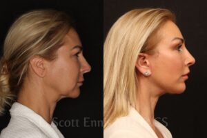 Endoscopic Brow lift Lower blepharoplasty deep plane facelift upper lip lift buffalo fat pad removal Ennis Plastic Surgery Before After Miami Boca Raton Palm Beach Fort Lauderdale Florida