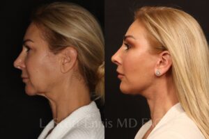Endoscopic Brow lift Lower blepharoplasty deep plane facelift upper lip lift buffalo fat pad removal Ennis Plastic Surgery Before After Miami Boca Raton Palm Beach Fort Lauderdale Florida