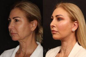Endoscopic Brow lift Lower blepharoplasty deep plane facelift upper lip lift buffalo fat pad removal Ennis Plastic Surgery Before After Miami Boca Raton Palm Beach Fort Lauderdale Florida