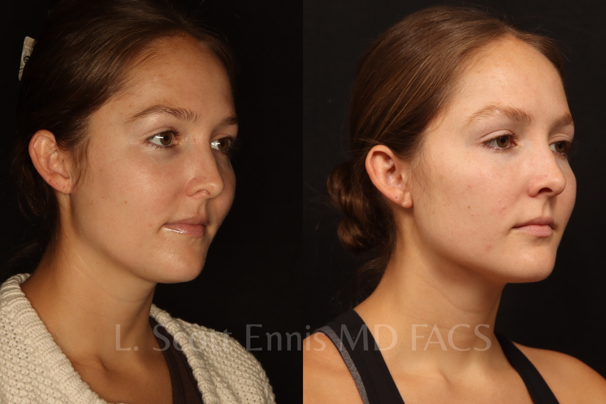 Neck liposuction before and after by Dr. Ennis of Ennis Plastic Surgery in Boca Raton Florida