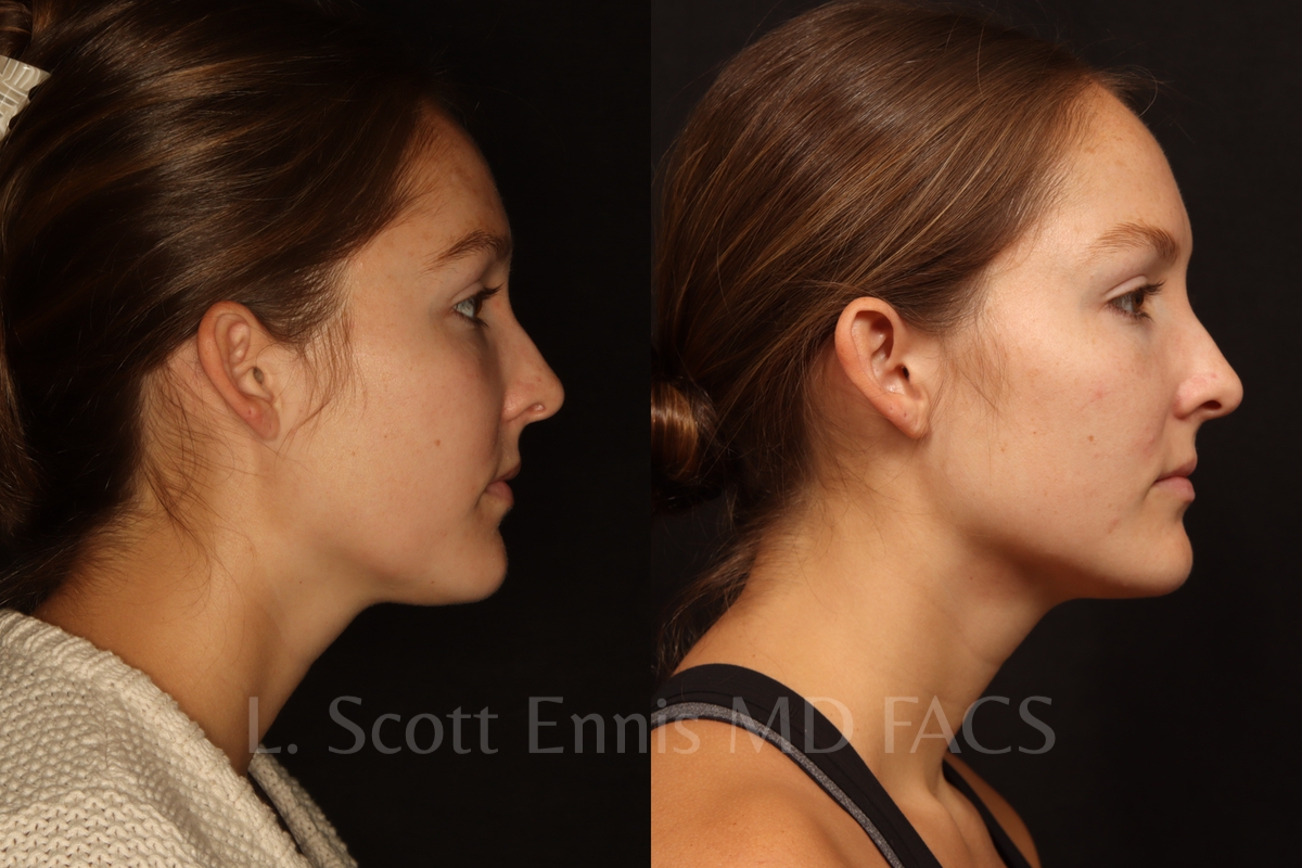 Neck liposuction before and after by Dr. Ennis of Ennis Plastic Surgery in Boca Raton Florida