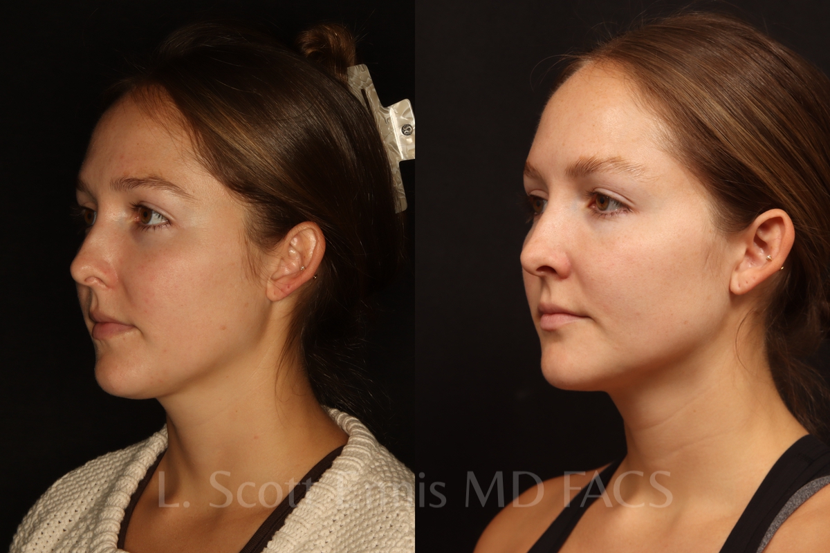 Neck liposuction before and after by Dr. Ennis of Ennis Plastic Surgery in Boca Raton Florida