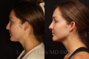 Liposuction-neck-boca-raton-miami-New-York-Beverly-hills-fortlauderdale-ennis-plastic-surgery-55703 (5)