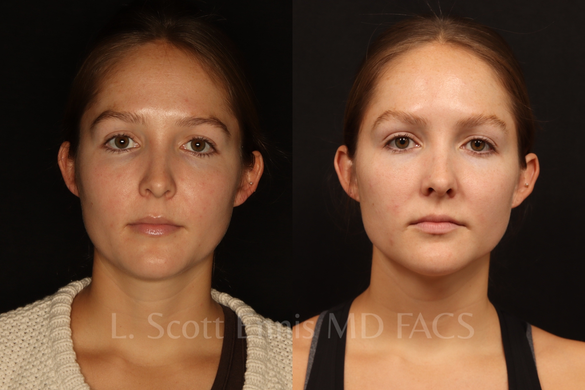 Neck liposuction before and after by Dr. Ennis of Ennis Plastic Surgery in Boca Raton Florida