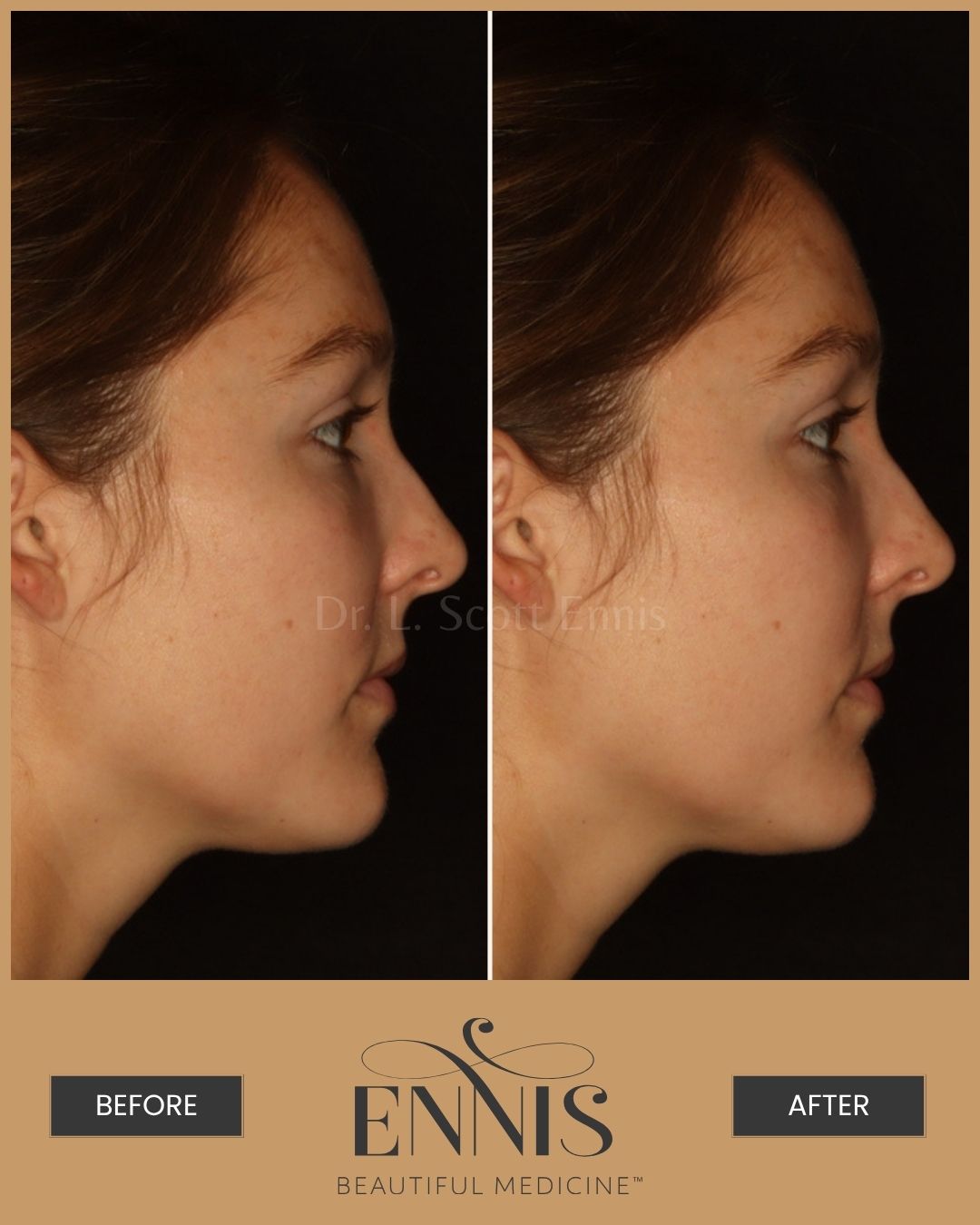 Liposuction-neck-boca-raton-miami-New-York-Beverly-hills-fortlauderdale-ennis-plastic surgery Neck liposuction before and after by Dr. Ennis of Ennis Plastic Surgery in Boca Raton Florida