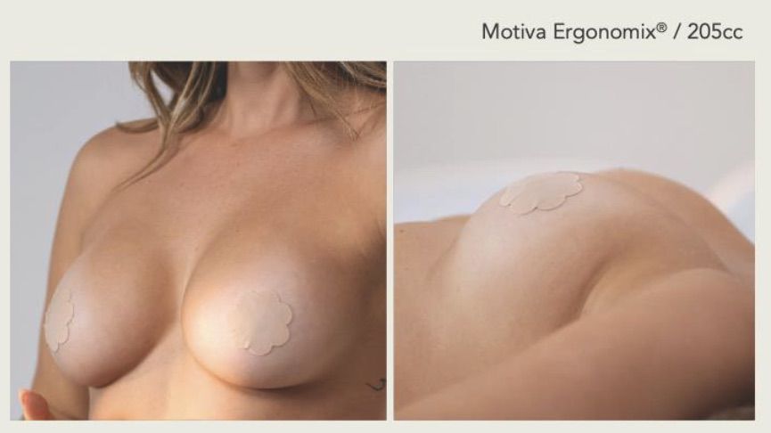 Preserve breast augmentation Ennis Plastic Surgery Florida0000